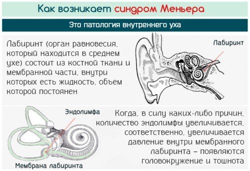 Запаморочення при синдромі Меньєра