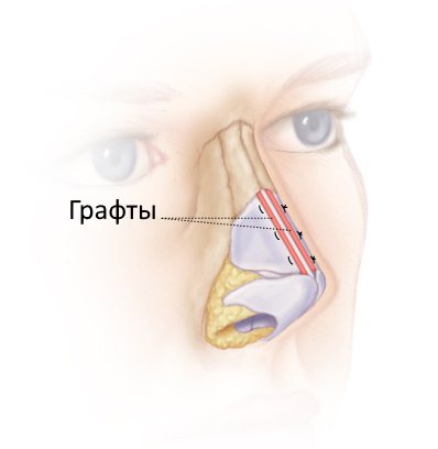 Графти для поліпшення дихання