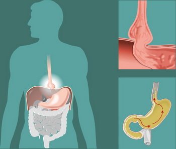 Що таке гастроезофагеальна рефлюксна хвороба, її симптоми і методи лікування
