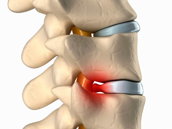 Грижа поперекового відділу хребта симптоми і лікування