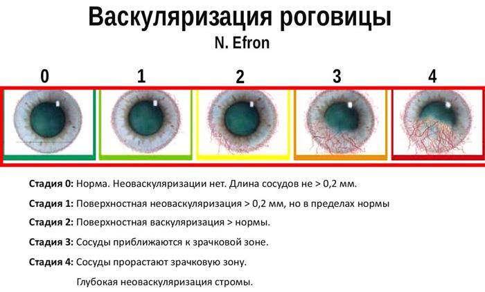 Через що може з’явитися синдром «сухого ока»?