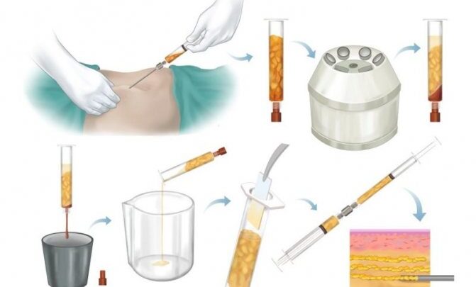 Ліпофілінг особи – плюси і мінуси популярної процедури