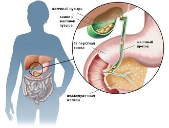 Холелітіаз Жовчнокам'яна хвороба чи інакше її називають холелітіаз