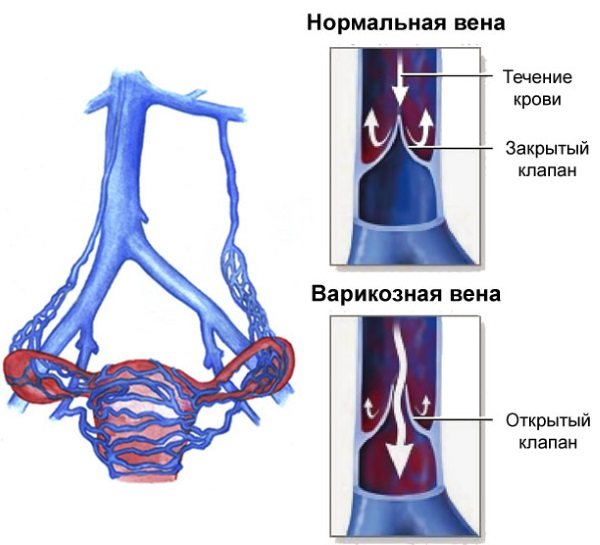 Хронічний апендицит у жінок.  Симптоми, діагностика, лікування