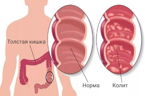 Хронічний апендицит у жінок.  Симптоми, діагностика, лікування