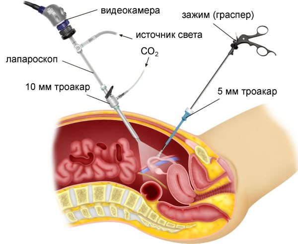 Хронічний апендицит у жінок.  Симптоми, діагностика, лікування