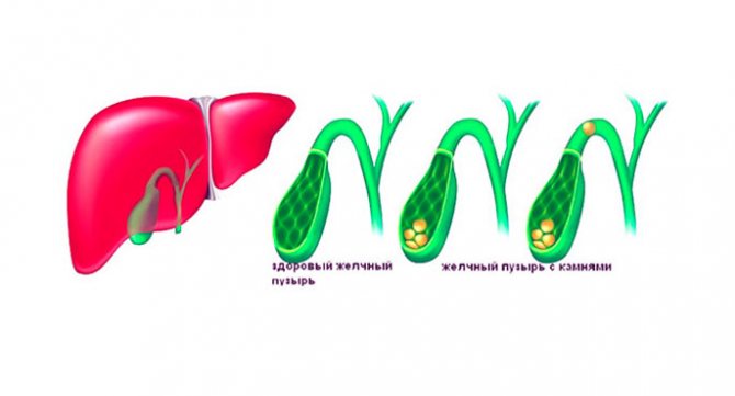 Хронічний калькульозний холецистит