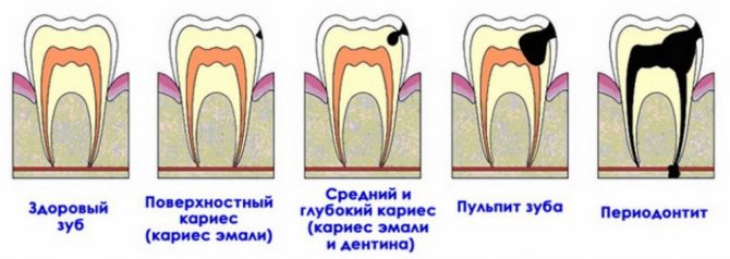 хронічний періодонтит