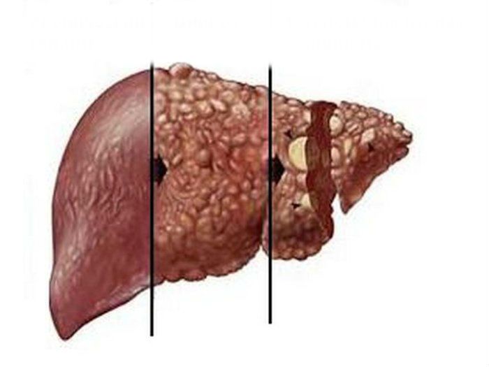 Доброякісна пухлина печінки – як лікувати, профілактика
