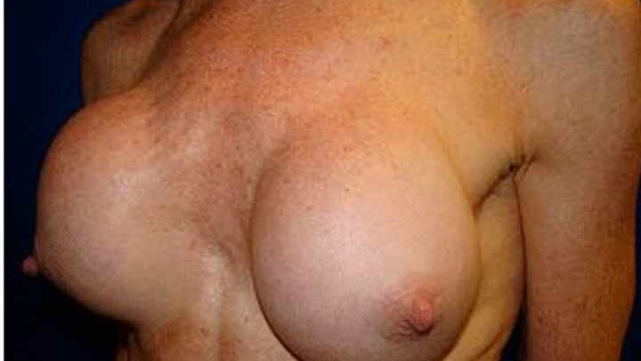 Установка імпланта під грудний м’яз: особливості, переваги та недоліки методу