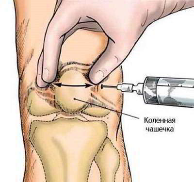 Ін'єкції в суглоб