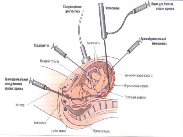Інвазивні методи дослідження при вагітності