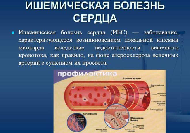 Ішемічна хвороба серця - що це таке