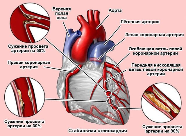 Ішемічна хвороба серця.  Симптоми і лікування, ознаки, рекомендації