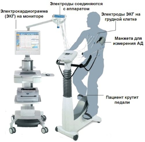 Ішемічна хвороба серця.  Симптоми і лікування, ознаки, рекомендації