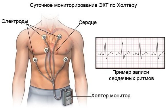 Ішемічна хвороба серця.  Симптоми і лікування, ознаки, рекомендації