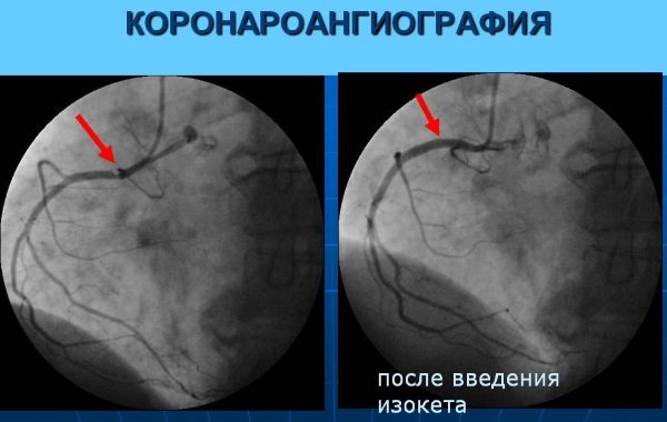 Ішемічна хвороба серця.  Симптоми і лікування, ознаки, рекомендації