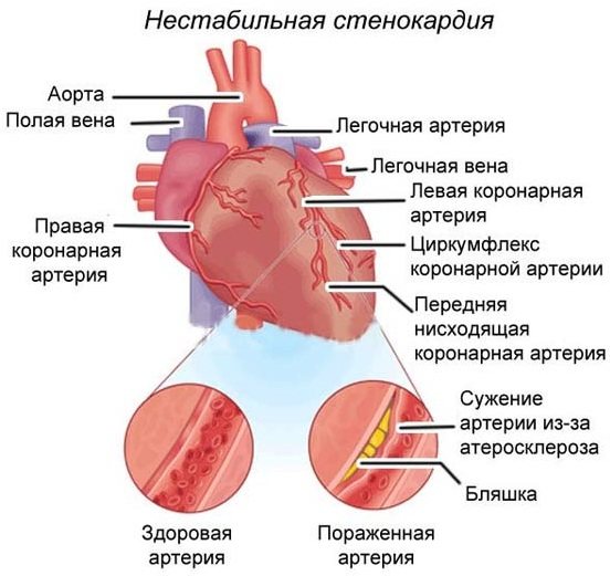 Ішемічна хвороба серця.  Симптоми і лікування, ознаки, рекомендації