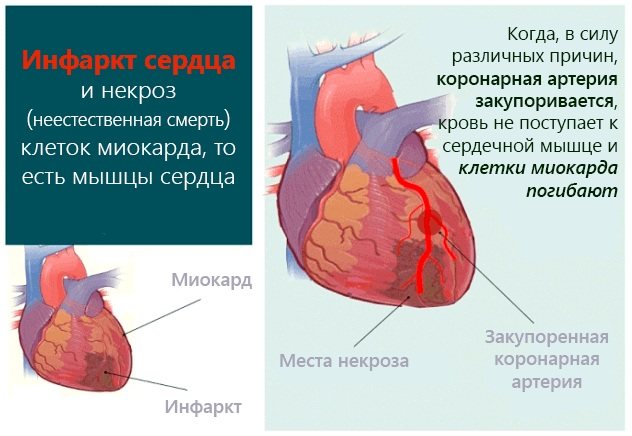 Ішемічна хвороба серця.  Симптоми і лікування, ознаки, рекомендації