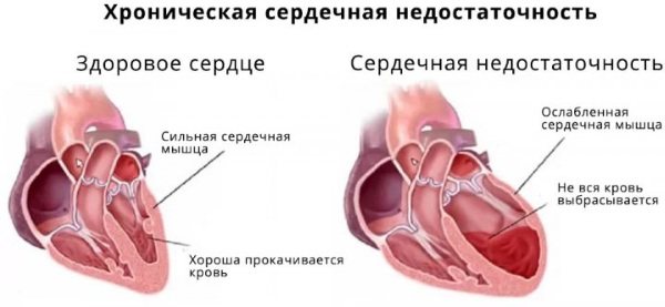 Ішемічна хвороба серця.  Симптоми і лікування, ознаки, рекомендації