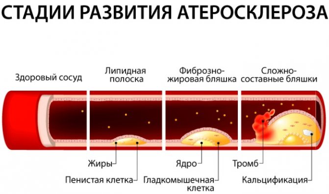 Ішемічна хвороба серця.  Симптоми і лікування, ознаки, рекомендації