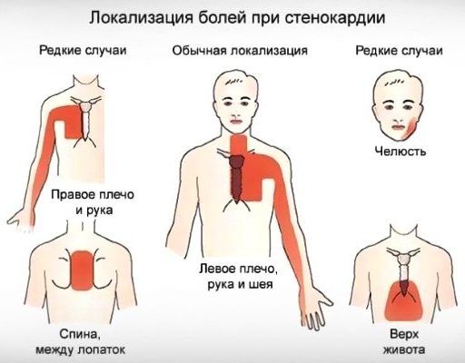 Ішемічна хвороба серця.  Симптоми і лікування, ознаки, рекомендації