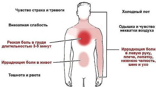 Ішемічна хвороба серця.  Симптоми і лікування, ознаки, рекомендації