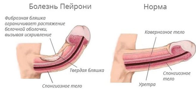 Як розв'язати проблему передчасного сім'явиверження — блог медичного центру ОН Клінік