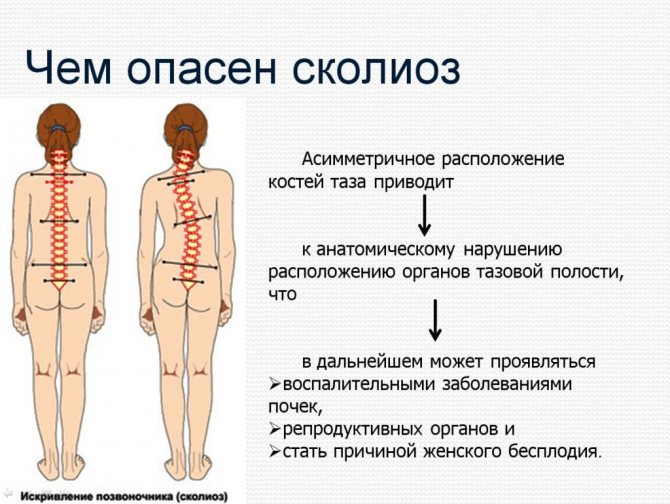 Викривлення хребта поперекового відділу