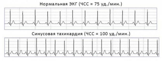 Штучна ЕКГ при здоровому серці і тахікардії