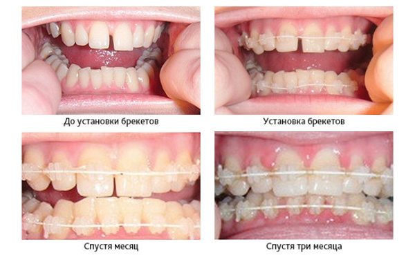 Зміна прикусу брекетами