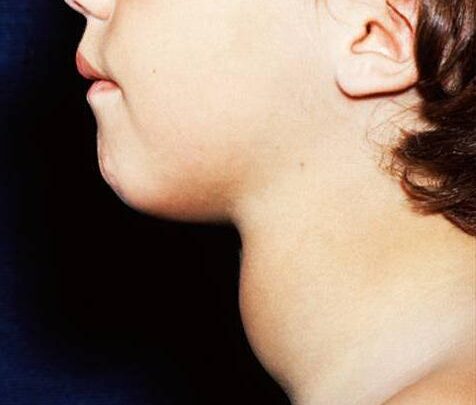 Очні краплі калію йодид інструкція із застосування