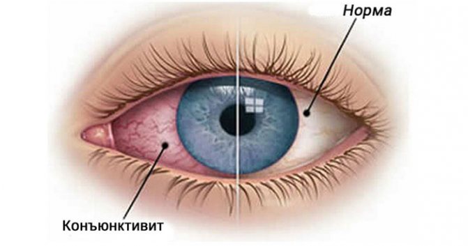 Як швидко вилікувати кон'юнктивіт у дітей в домашніх умовах аптечні краплі і народні засоби