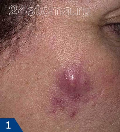 Як лікувати фурункул на обличчі, лобі, щоці: прибрати чиряк