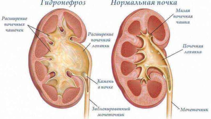 Гідронефроз: як не стати жертвою «мовчазної вбивці»