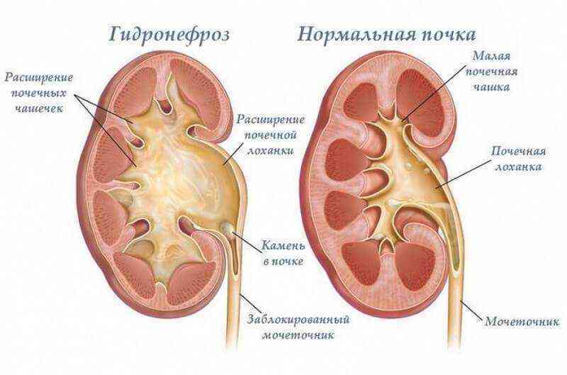 Гідронефроз: як не стати жертвою «мовчазної вбивці»