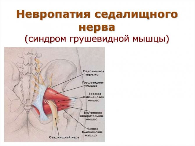 Як лікувати ішіас (запалення сідничного нерва) будинку, терапія в домашніх умовах