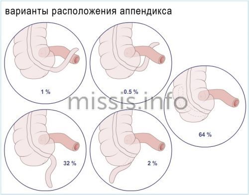 Як може розташовуватися апендикс