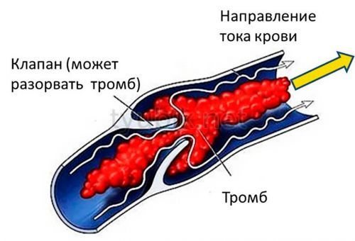 Як утворюється тромб