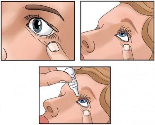 Рекомендації по використанню очних крапель Ципролет