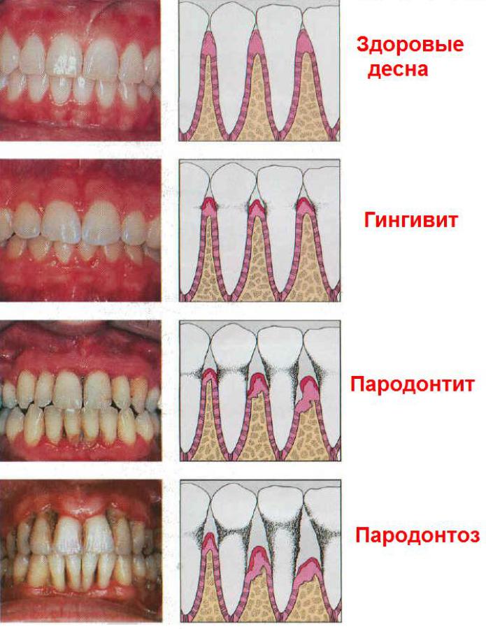 Як приймати шавлія при запаленні ясен і зубного болю.  Суперкорисне рослинний засіб