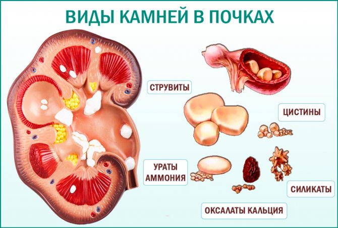 Камені в нирках: які бувають і від чого з'являються