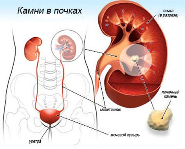 Камені в нирках