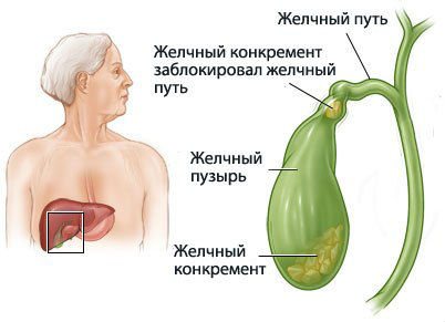 Жовчнокам’яна хвороба – симптоми і лікування без операції