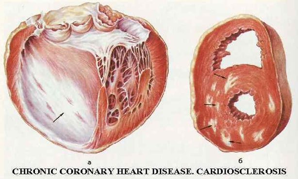кардіосклероз