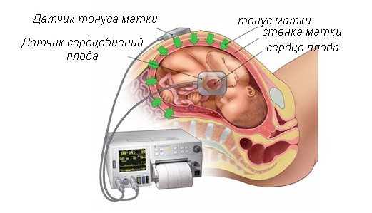 кардіотокографія плода