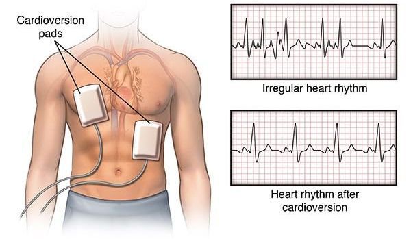 кардіоверсія