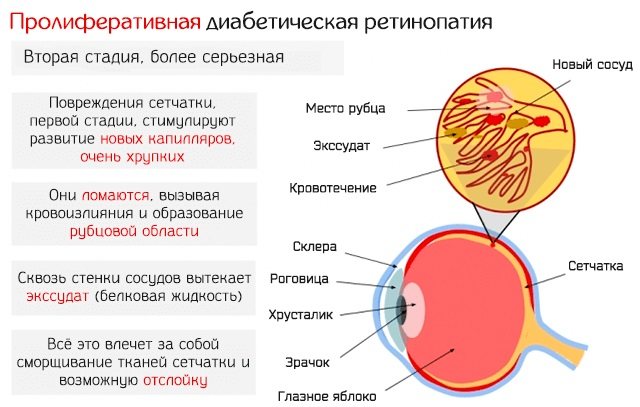 Катаракта.  Причини, симптоми, лікування і профілактика.  Народні засоби, операція