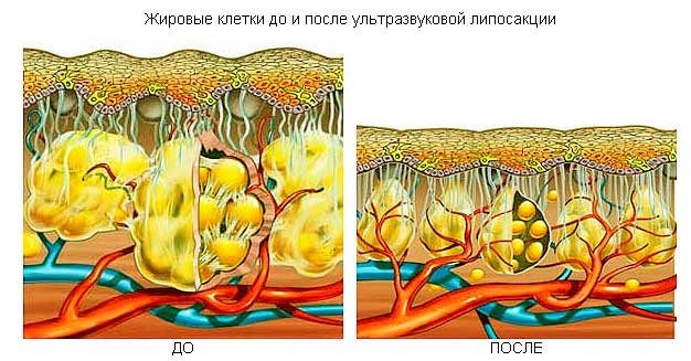 Кавітація: протипоказання, показання та умови виконання процедури