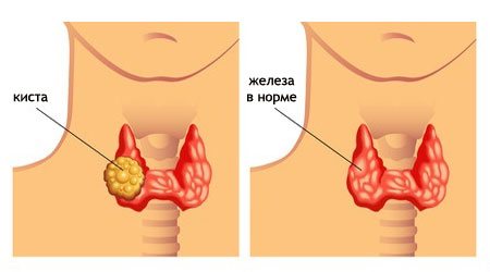 кіста щитовидної залози що це таке як лікувати